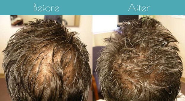 Hair Loss Treatment Fort Lauderdale | Hair Restoration Specialists Miami  Florida | Alexander Hair One